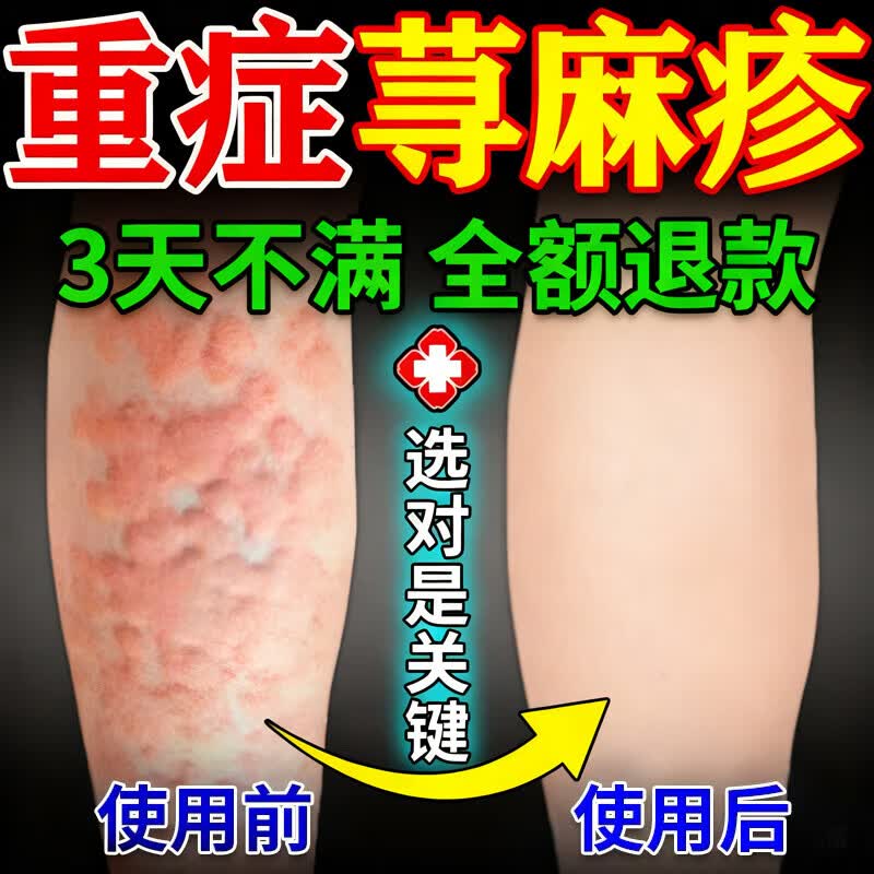 茹念百易方荨麻疹膏根(药监备案)过敏止痒断膏寻麻家庭护理家庭护理 3盒装[当晚见表现]买二送一