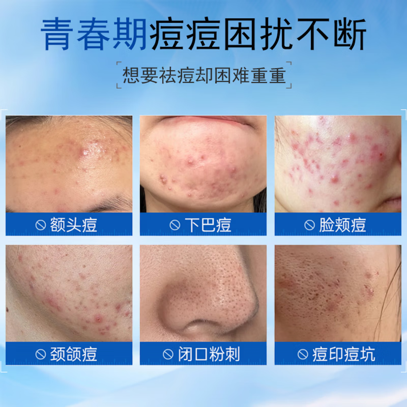 梦若羽eak祛痘凝胶【官方直售】淡化痘印去豆痘坑闭口粉刺青春痘痘黑头 【99%的顾客选择】买三赠二 5支装 【官方旗舰 京质保障】