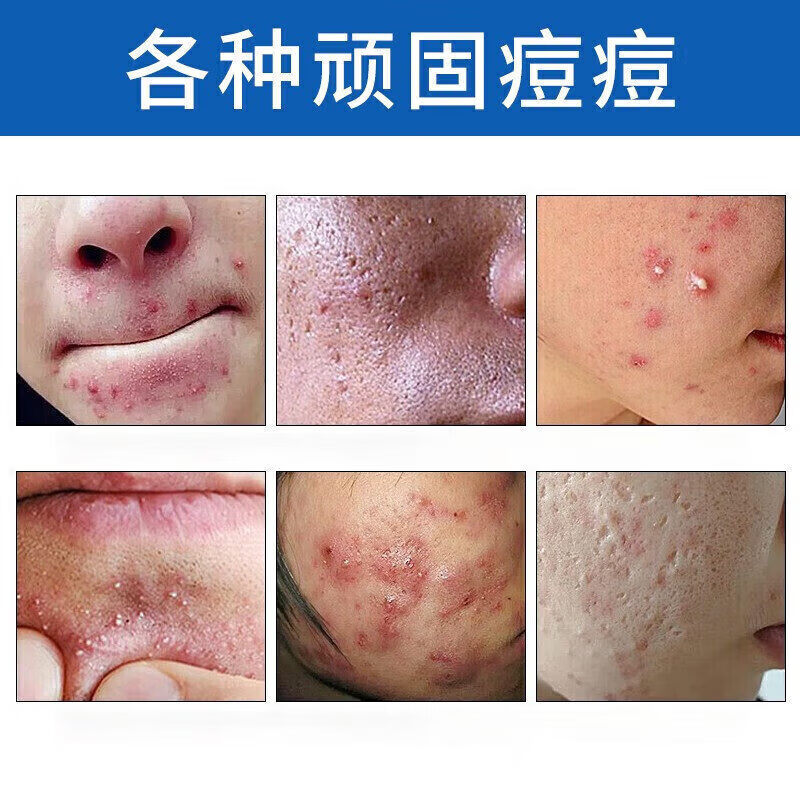 熏姿颜积雪草苷凝乳膏胶法痘痘印去痘坑痘疤修复淡化凝胶精华液消印 5支 买3赠2【巩固装】 【官方旗舰京质保障】