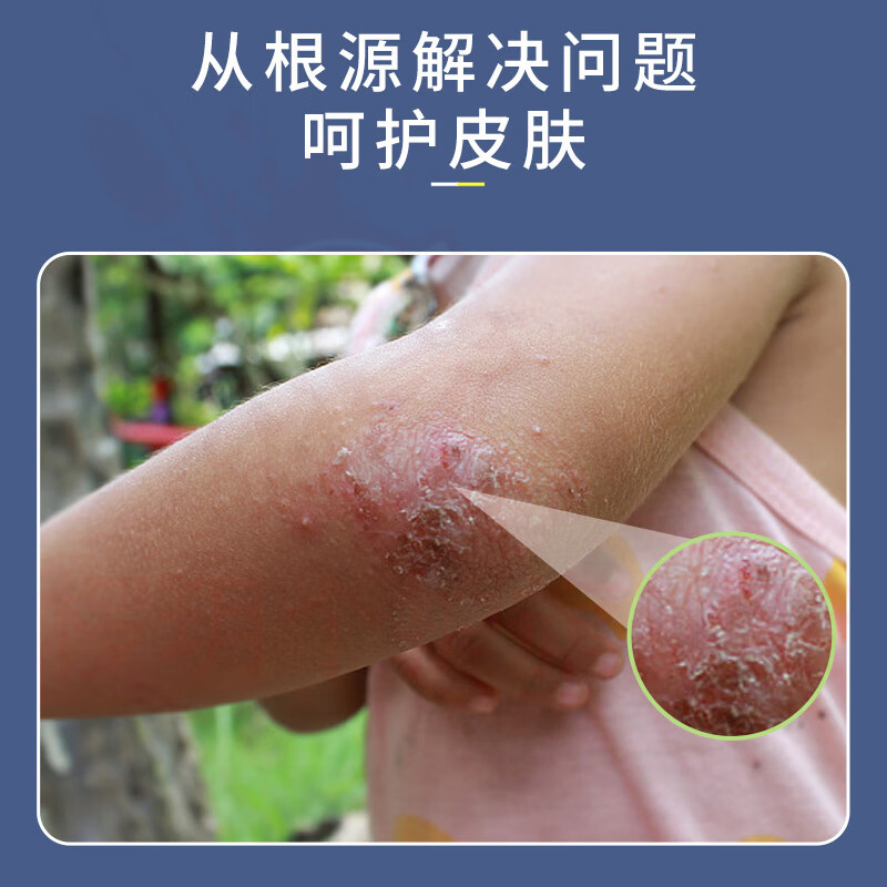 熏姿颜柏可芬软膏湿疹膏皮肤止痒外用顽固皮炎阴囊肛门瘙痒汗泡疱疹药膏 1盒见效装 官方自售