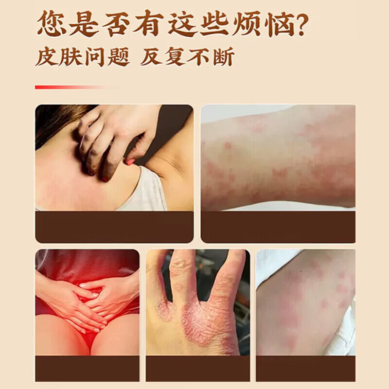 北京协和医学院止痒膏止痒抑菌皮肤瘙痒身体痒止痒特效湿炎皮疹真菌感染过敏药膏 1盒【皮肤瘙痒止痒祛湿毒】药膏 港真菌王百草止痒王去裉湿毒清