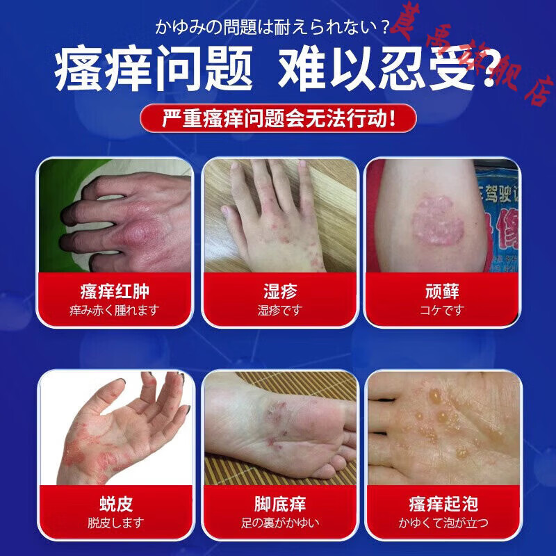 熏姿颜东曲达大多维硒荨麻疹湿疹过敏性膏治皮肤痒瘙痒止痒抑菌慢性正品 2盒【轻度装】 官方直售