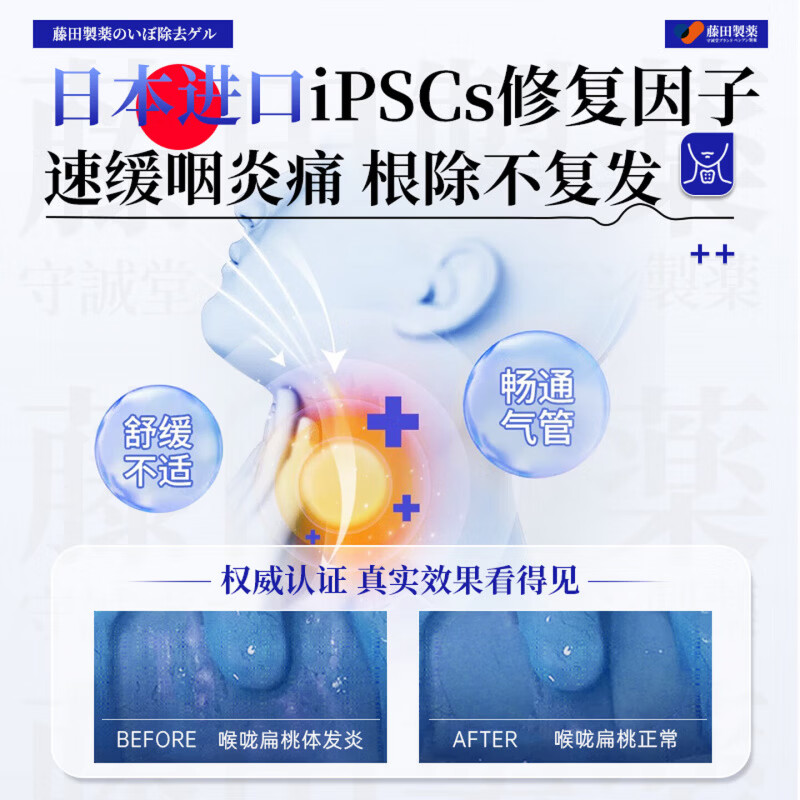 BEIYVS复方福可定口服溶液慢性咽炎化痰嗓子喉咙干痒干咳异物感喷剂 5瓶巩固装【不易反复】 【官方直售】