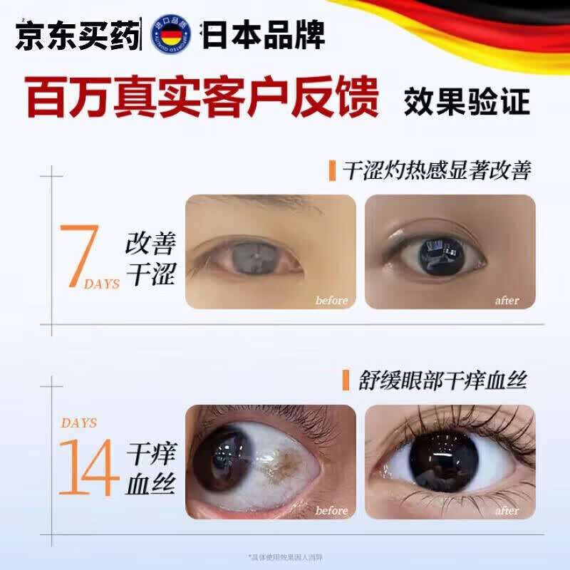 LUJAHA素滴眼液日本进口抗真菌感染结膜炎睑炎眼睛红肿红血丝
1盒【改善装】疲劳干涩 【官方直售】