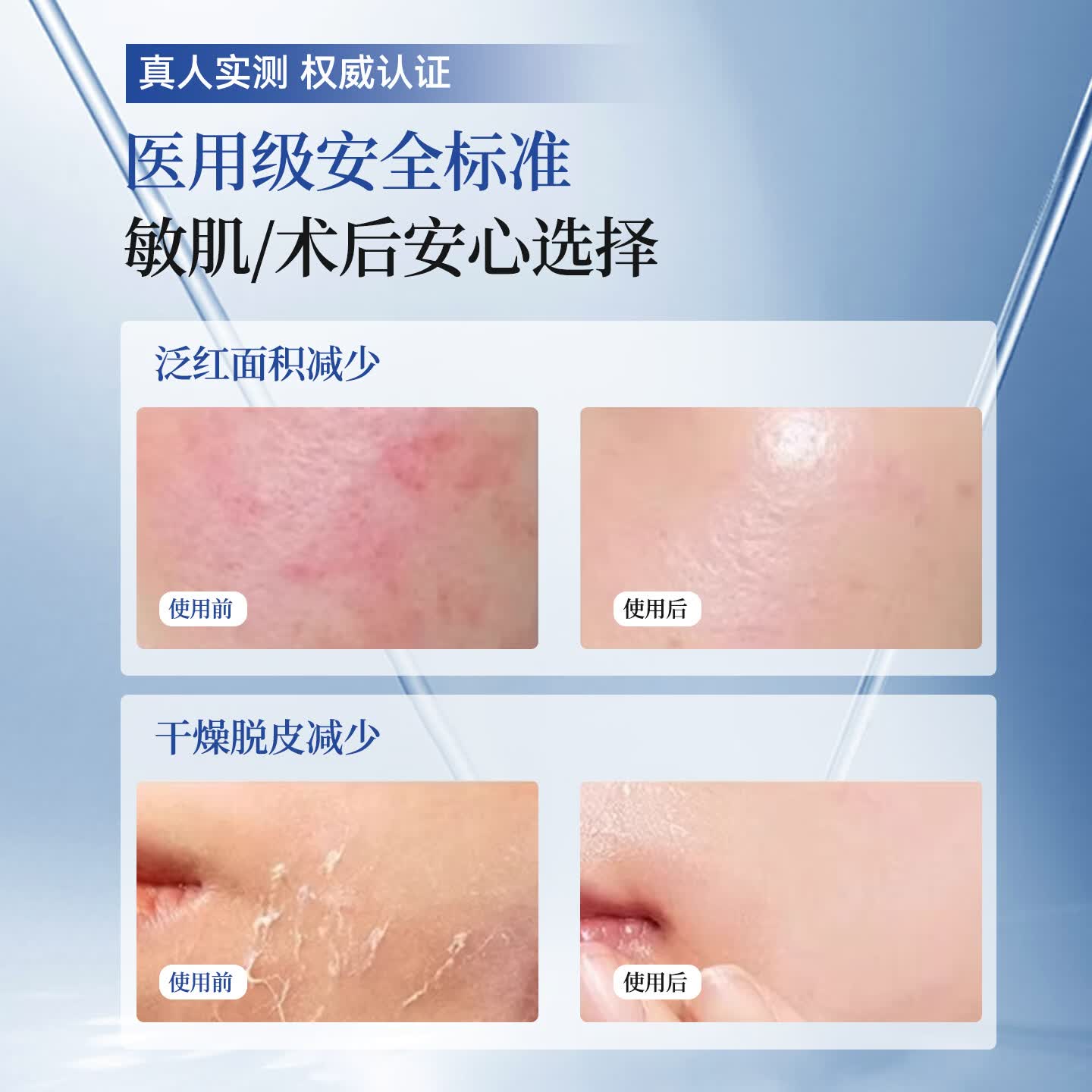 光域·环曜（GLUMISPHERE）透明质酸钠重组胶原蛋白无菌液体敷料微整形术后创口修复皮肤护理