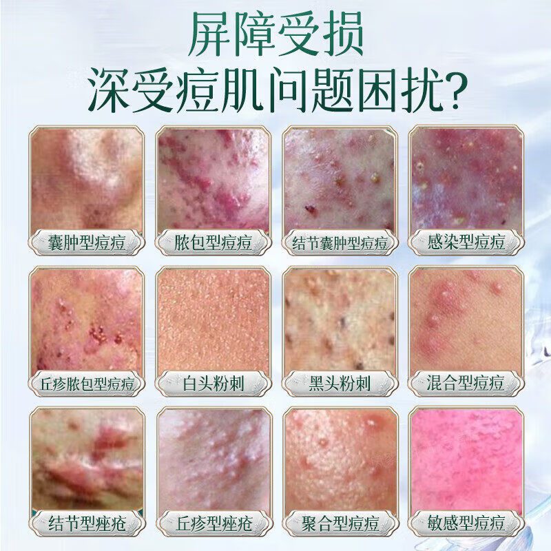 熏姿颜积雪草苷凝乳膏胶法痘痘印去痘坑痘疤修复淡化凝胶精华液消印 5支 买3赠2【巩固装】 【官方旗舰京质保障】