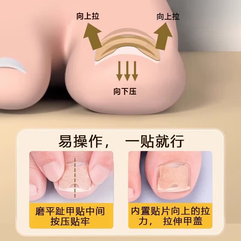 ZYUO甲沟炎器贴片脚指甲长肉里专用正甲贴片甲沟嵌甲器趾甲
100贴【品质保障】 无痛矫正 不再扎肉