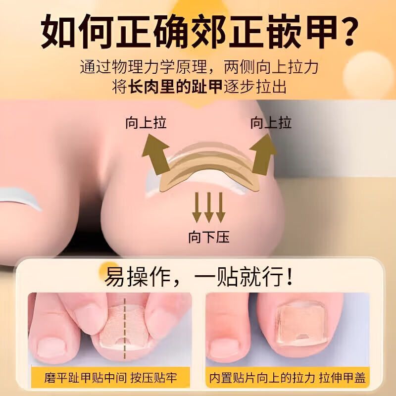 ZYUO甲沟炎器贴片脚指甲长肉里专用正甲贴片甲沟嵌甲器趾甲
100贴【品质保障】 无痛矫正 不再扎肉