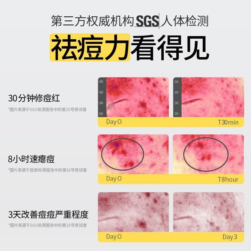 羽素祛痘大灯泡15ml【原装正品】快速去痘修护舒缓痘肌防反复精华 大灯泡祛痘精华15ml