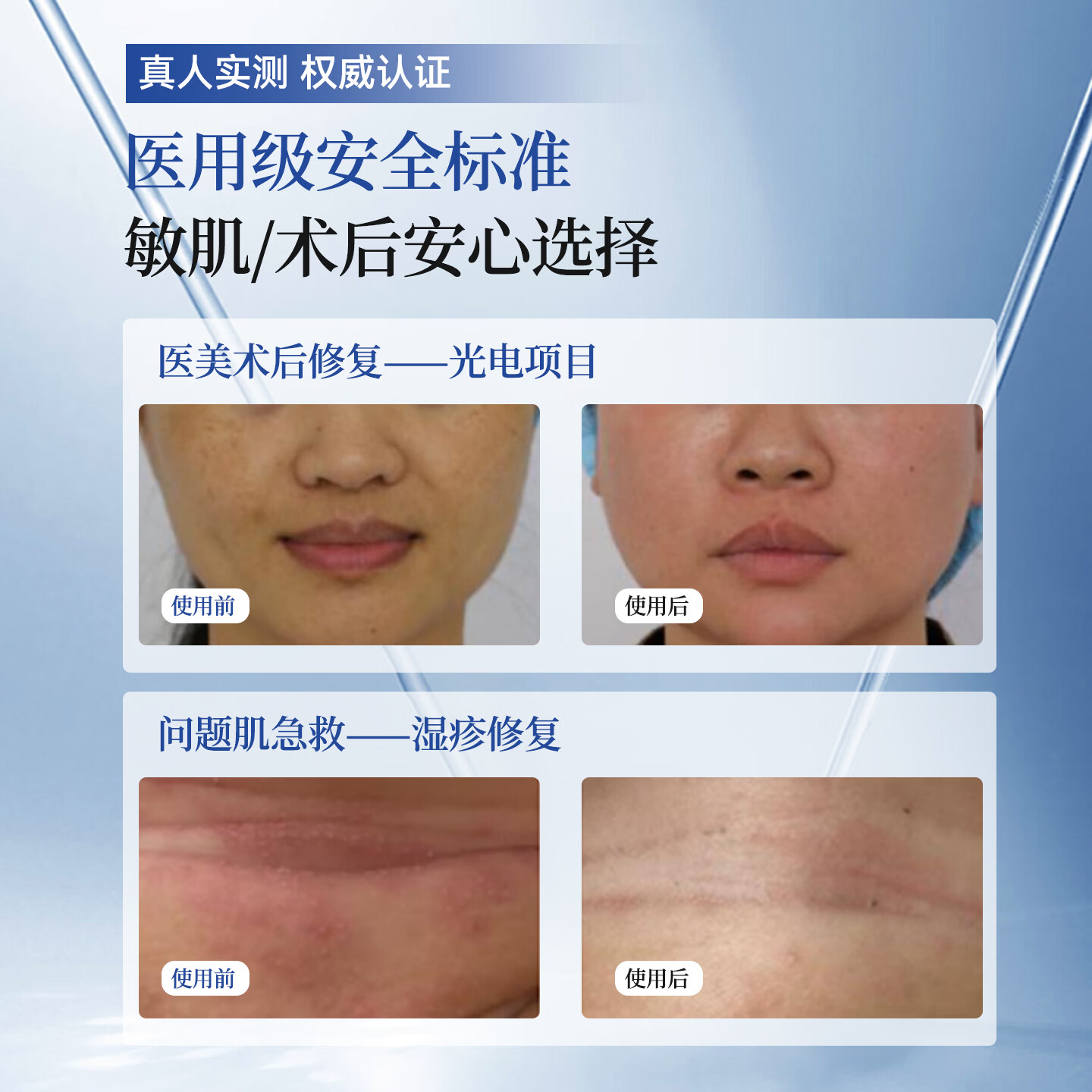 灵溯·界医用重组贻贝粘蛋白凝胶物理屏障微整形创口光子果酸皮肤修复护理