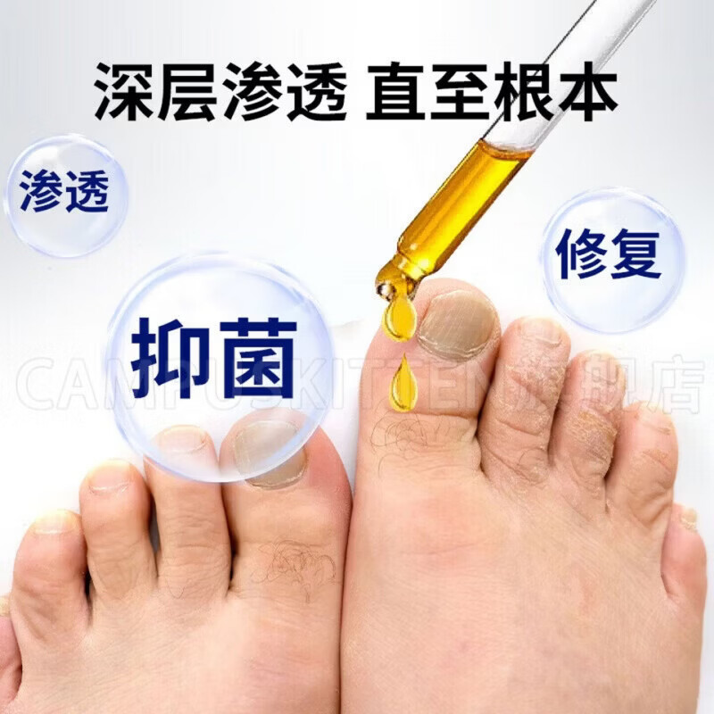 BEIYVS郑远元灰指甲抑菌液【官方旗舰正品】搽剂杀菌脱甲膏 5瓶【巩固完善囤货装】 【官方直售】