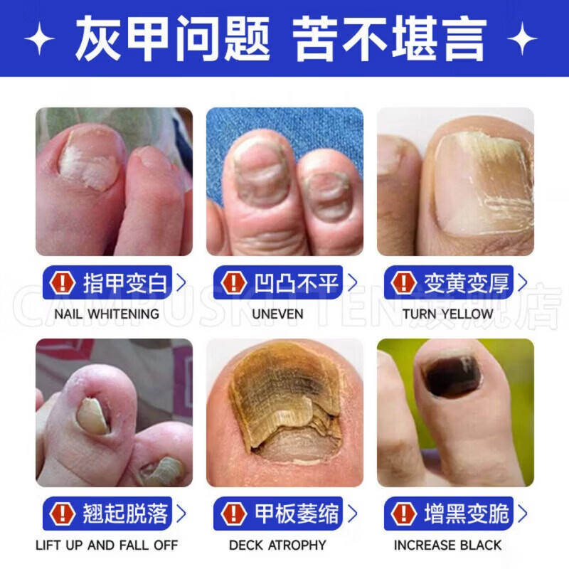 BEIYVS郑远元灰指甲抑菌液【官方旗舰正品】搽剂杀菌脱甲膏 5瓶【巩固完善囤货装】 【官方直售】