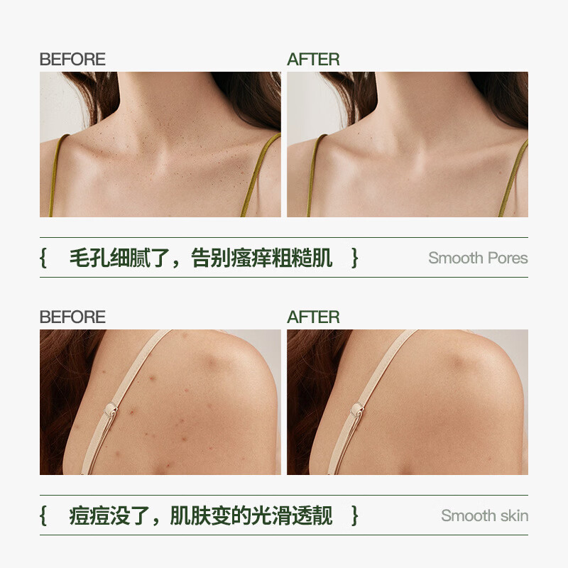 BEIYVS蓓安亲研祛痘喷雾后背祛痘喷雾前胸口背部身体去痘美背水杨酸背粒 5瓶巩固完善装【背痘全不见】 【官方直售】