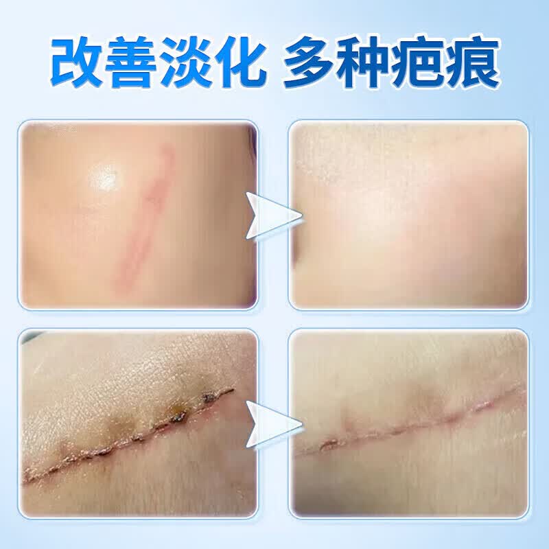 邦院长医用祛疤膏祛疤痕专用修复灵剖腹产烧烫伤增生手术缝针去疤痕凝胶 2盒周期装【轻微疤痕适用】