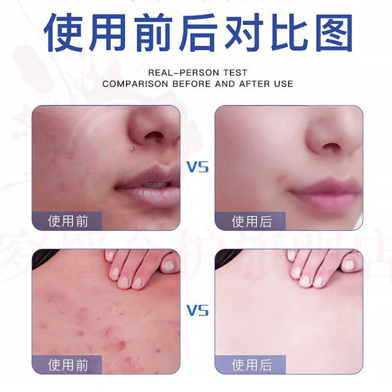 思亚希蓓安亲研祛痘喷雾后背前胸口美背部身体去痘水杨酸淡化痘印改善痘 5瓶 囤货装 官方自售