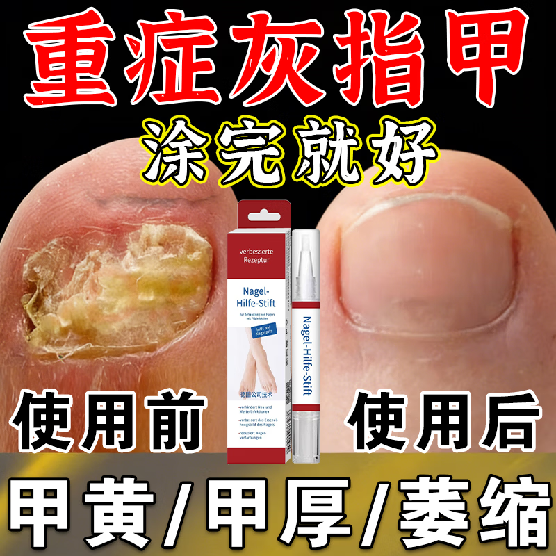 L0【德国进口】灰指甲笔抑菌液去灰指甲甲增厚专用修复指甲护理正品 【重度疗程】灰指甲笔*3.