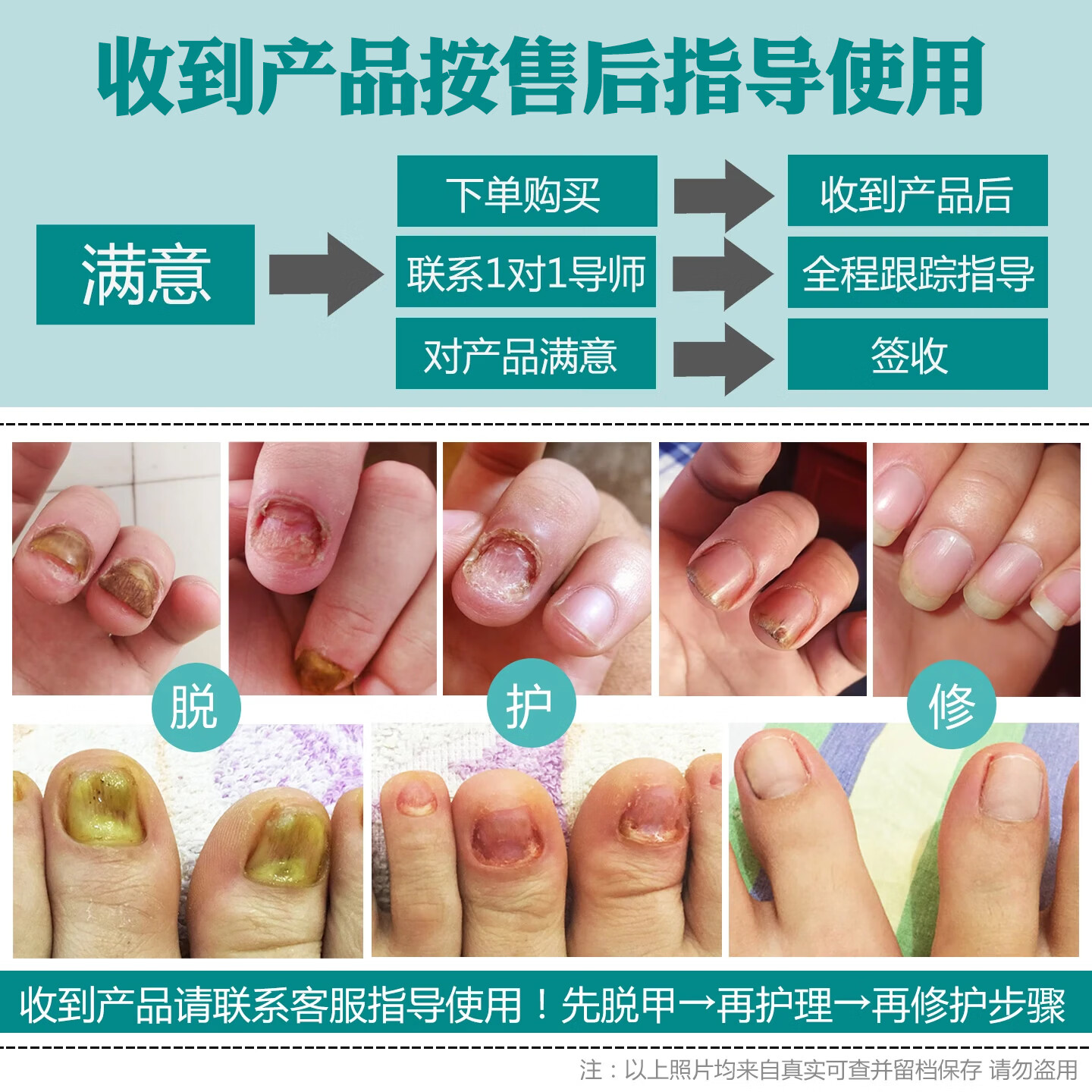 润芷堂灰指甲用组合套装专用液灰指甲增厚萎缩分层凹凸不平白甲甲沟炎等