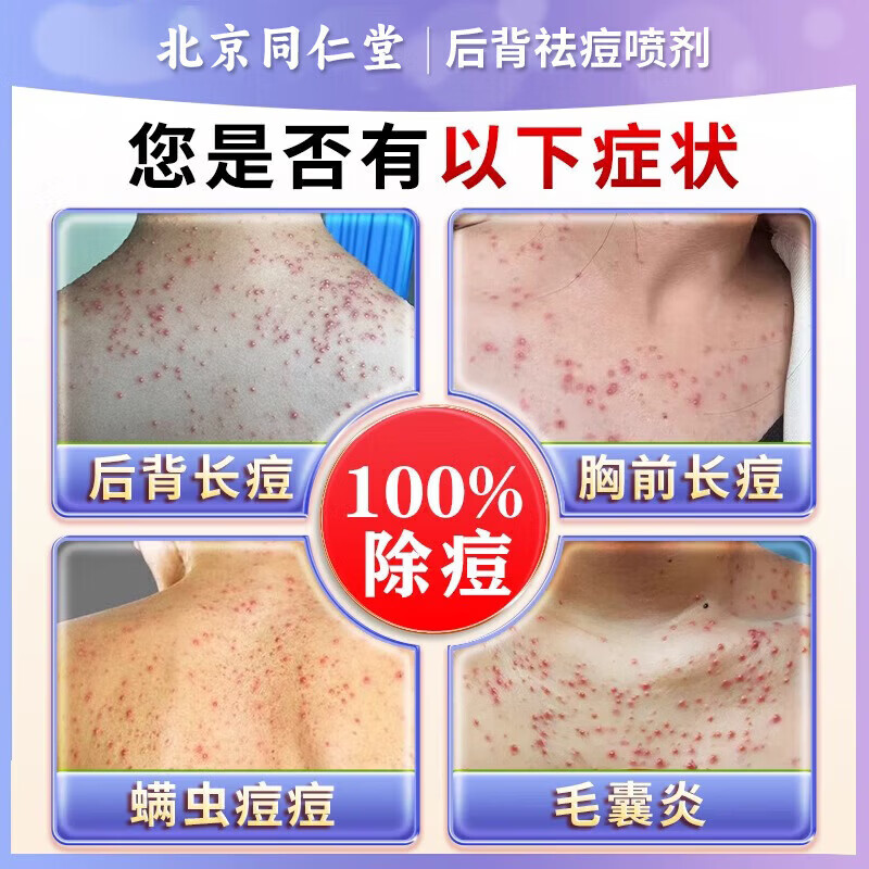 东田后背痘痘药膏后背长痘痘毛囊炎专用前胸后背部脓包痤疮 一盒装【多买多送】发货特效快 祛痘喷雾剂