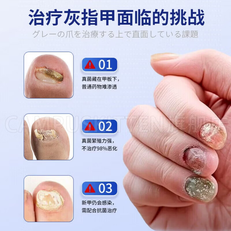 BEIYVS郑远元灰指甲抑菌液【官方旗舰正品】搽剂杀菌脱甲膏 5瓶【巩固完善囤货装】 【官方直售】