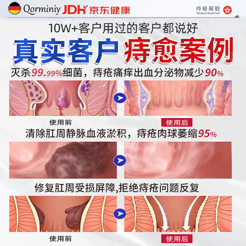 Qorminiy德国痔i疮膏去i肉球内外混合痔疮专用非药卡波姆痔疮凝胶断i根膏 买2送1【肉球脱出-便血肿胀特效】3盒疗程装 【1支见效】断肉球内外混合痔疮专用非药