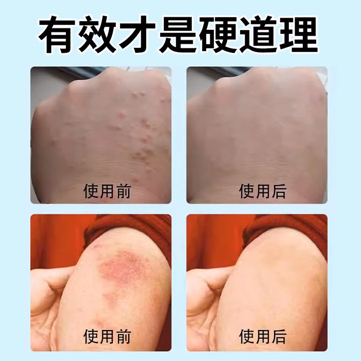 新适确得卤i米松三i氯生乳膏适用于脂溢性皮炎痒湿湿疹神经性皮炎抑菌止痒 两支疗程装 【正品直售 京质保障】
