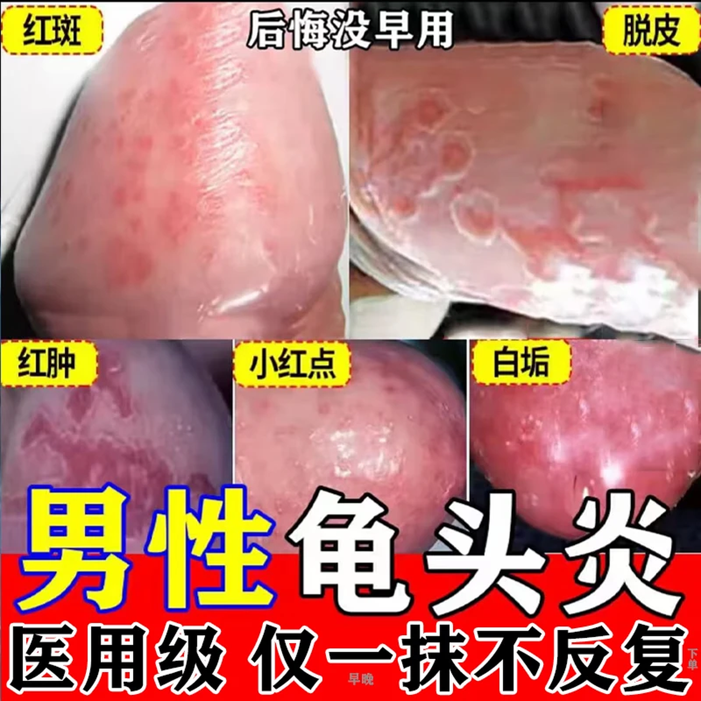 [恒久远]克霉唑乳膏 10g 3盒装 克霉唑乳膏男性龟头炎白垢豆腐渣专用膏药正品男士龟头炎真菌感染红肿专用特新效期药 男士龟头炎真菌感染专用药京东