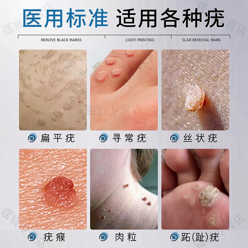 宫束液氮冷冻去疣医用液氮脚跖疣寻常疣鸡眼物理疣小肉粒疙瘩液态冷冻 液态冷冻700赠配件 正品保证 京质保障