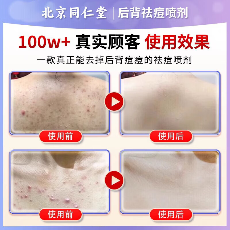 东田后背痘痘药膏后背长痘痘毛囊炎专用前胸后背部脓包痤疮 一盒装【多买多送】发货特效快 祛痘喷雾剂
