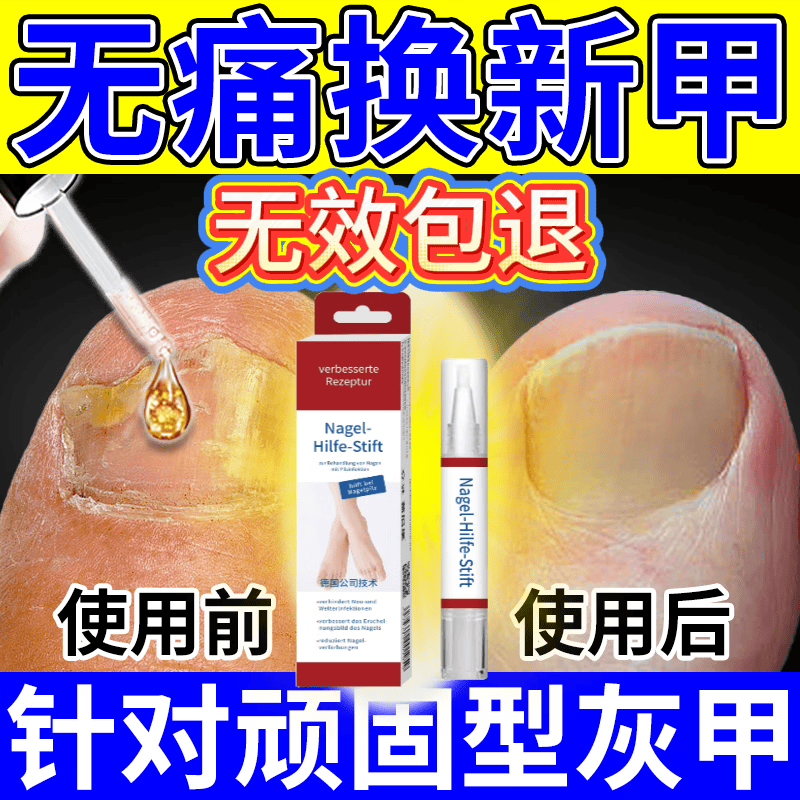 L0【德国进口】灰指甲笔抑菌液去灰指甲甲增厚专用修复指甲护理正品 【重度疗程】灰指甲笔*3