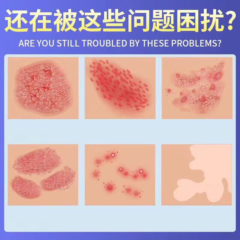 众乐康健(ZHONGLEKANGJIAN)手上起小水泡手痒指长非汗状泡疹专用软膏止痒汗包膏汗泡膏汗孢疹 3盒装【买2送1巩固装】