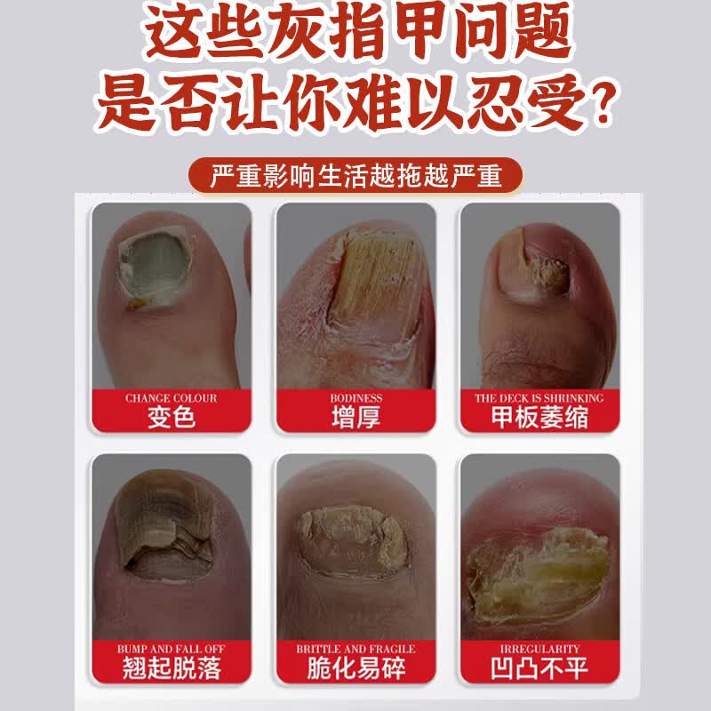 L0【德国进口】灰指甲笔抑菌液去灰指甲甲增厚专用修复指甲护理正品 【重度疗程】灰指甲笔*3