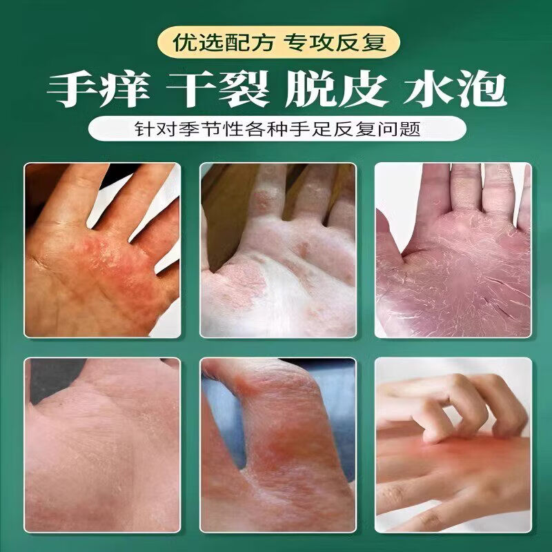 众乐康健(ZHONGLEKANGJIAN)手上起小水泡手痒指长非汗状泡疹专用软膏止痒汗包膏汗泡膏汗孢疹 3盒装【买2送1巩固装】