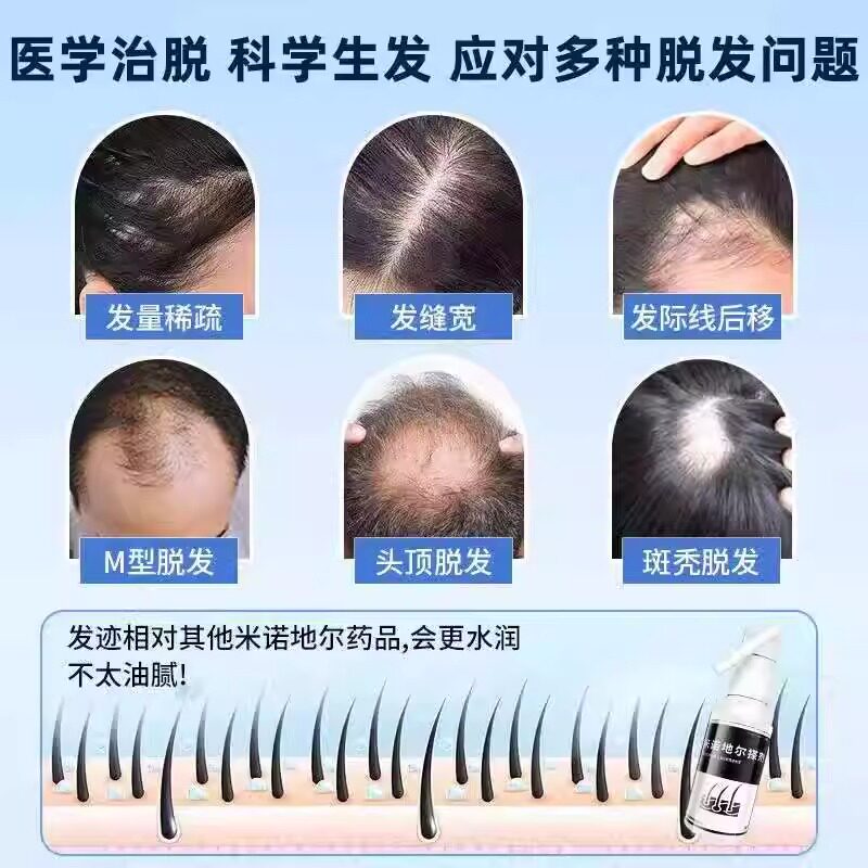 [威郎中]米诺地尔搽剂 5%*60ml 1盒装 男女士专用防治脱发密发增发生发液剂酊激活毛囊斑秃掉发国药准字发际线生发液3g 1个月用量 官方正品