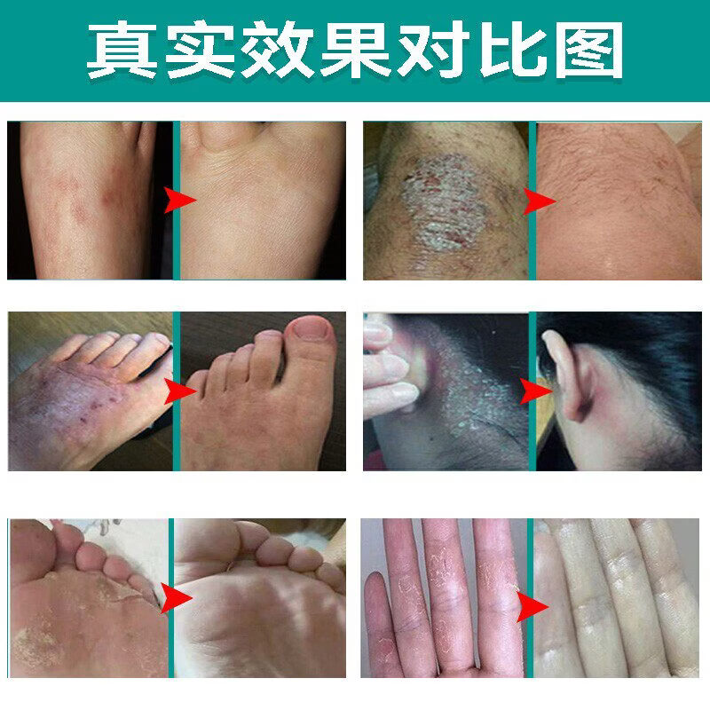 众乐康健(ZHONGLEKANGJIAN)手上起小水泡手痒指长非汗状泡疹专用软膏止痒汗包膏汗泡膏汗孢疹 3盒装【买2送1巩固装】