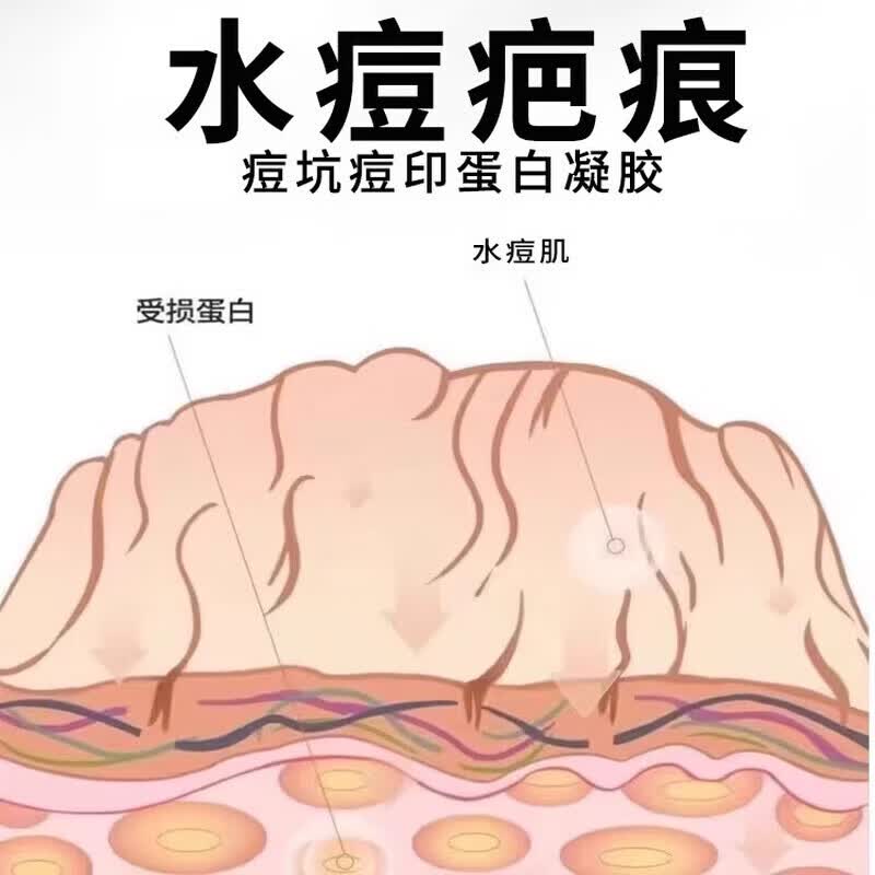 修正水痘疤痕修复凝胶水痘坑痘印复凹洞搭配生长因子祛陷疤膏儿童成人 单盒【体验装】