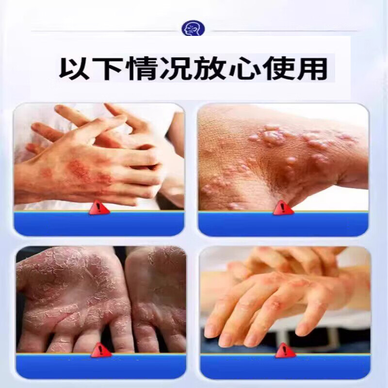 众乐康健(ZHONGLEKANGJIAN)手上起小水泡手痒指长非汗状泡疹专用软膏止痒汗包膏汗泡膏汗孢疹 3盒装【买2送1巩固装】