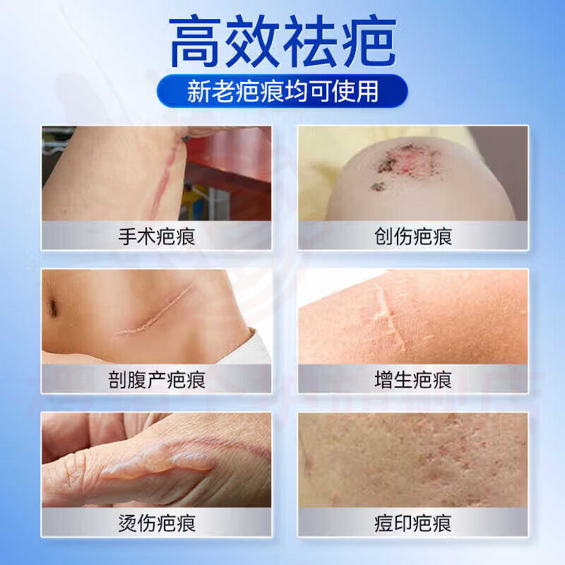 熏姿颜贝士鑫医用疤痕硅酮凝胶修复术后烧烫伤生长纹妊娠纹增生官方正品 5盒周期装【针对严重疤痕】 官方自售