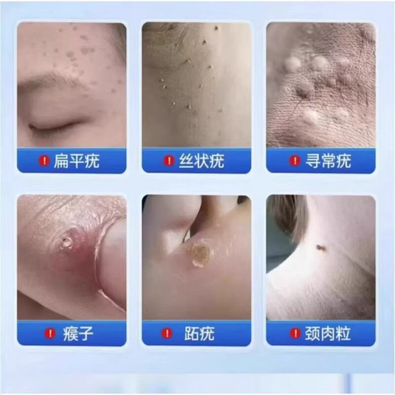 君医师抗hpv生物蛋白液体敷料扁平疣丝状尤祛脖子上长小肉粒瘊子 两瓶【优惠装】 【官方正品 京质保障】