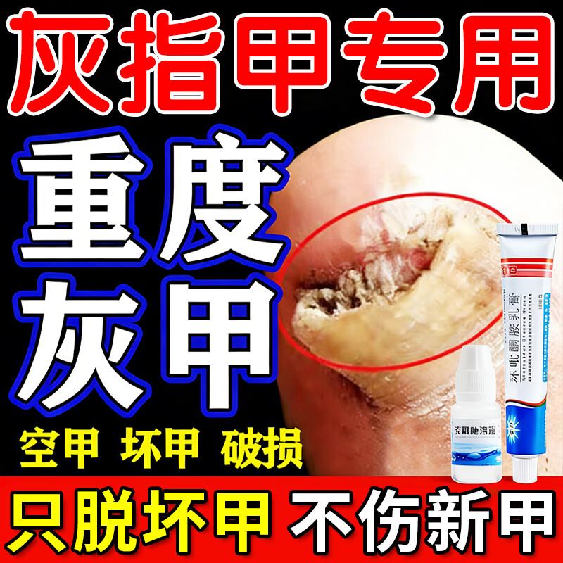 [金归]环吡酮胺乳膏 治疗灰指甲专用药最特新效药指甲增厚发黄变厚重度指甲手足真菌感染根药治皮肤用药 1%*20g 1盒装 【+1溶液 治疗效果佳】 京东折扣/优惠券