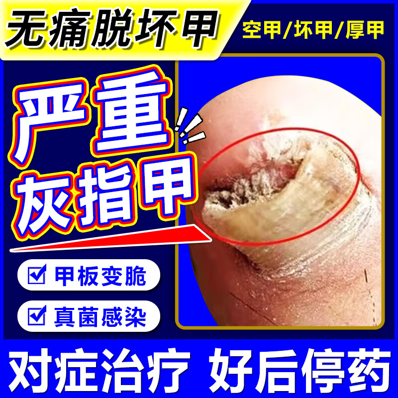 [金归]环吡酮胺乳膏 治疗灰指甲专用药最特新效药指甲增厚发黄变厚重度指甲手足真菌感染根药治皮肤用药 1%*20g 1盒装 【建议多盒治】