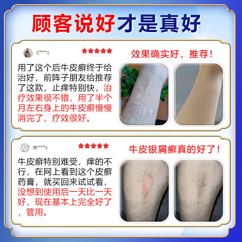 北京协和医学院牛皮癣断根药皮肤癣膏药真菌止痒抑菌皮肤顽固牛皮癣i药膏进口 特强效3盒【500%必裉除】 银屑病牛皮癣皮肤癣专用特强效膏