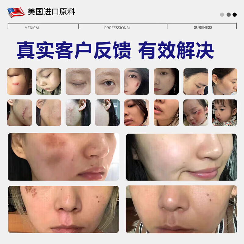 芭克疤巴克祛疤膏美国进口去疤痕修复正品凝胶剖腹产烫伤药膏儿童专用 特效五盒[强烈推荐家庭备用15g*5