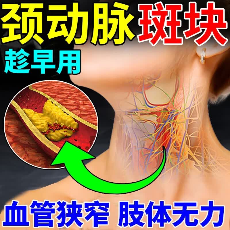 内廷上用颈动脉血管斑块堵塞疏通颈血管清理血管堵塞狭窄疏通脑供血不足贴 单盒【头晕 脑供血不足】