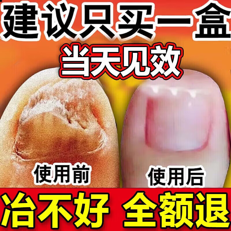 国药药材灰指甲特殊效第1名增厚发黄变空甲中沟草灰甲亮甲凤仙花液 【一个灰甲一盒就行】一盒装 灰指甲100%特效专用的药第一名 京东折扣/优惠券