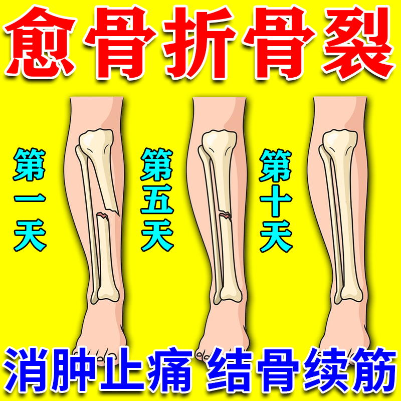 进口骨折骨裂恢复的药促进骨折愈合快速接骨跌打损伤消肿止痛有药 一瓶【体验装】