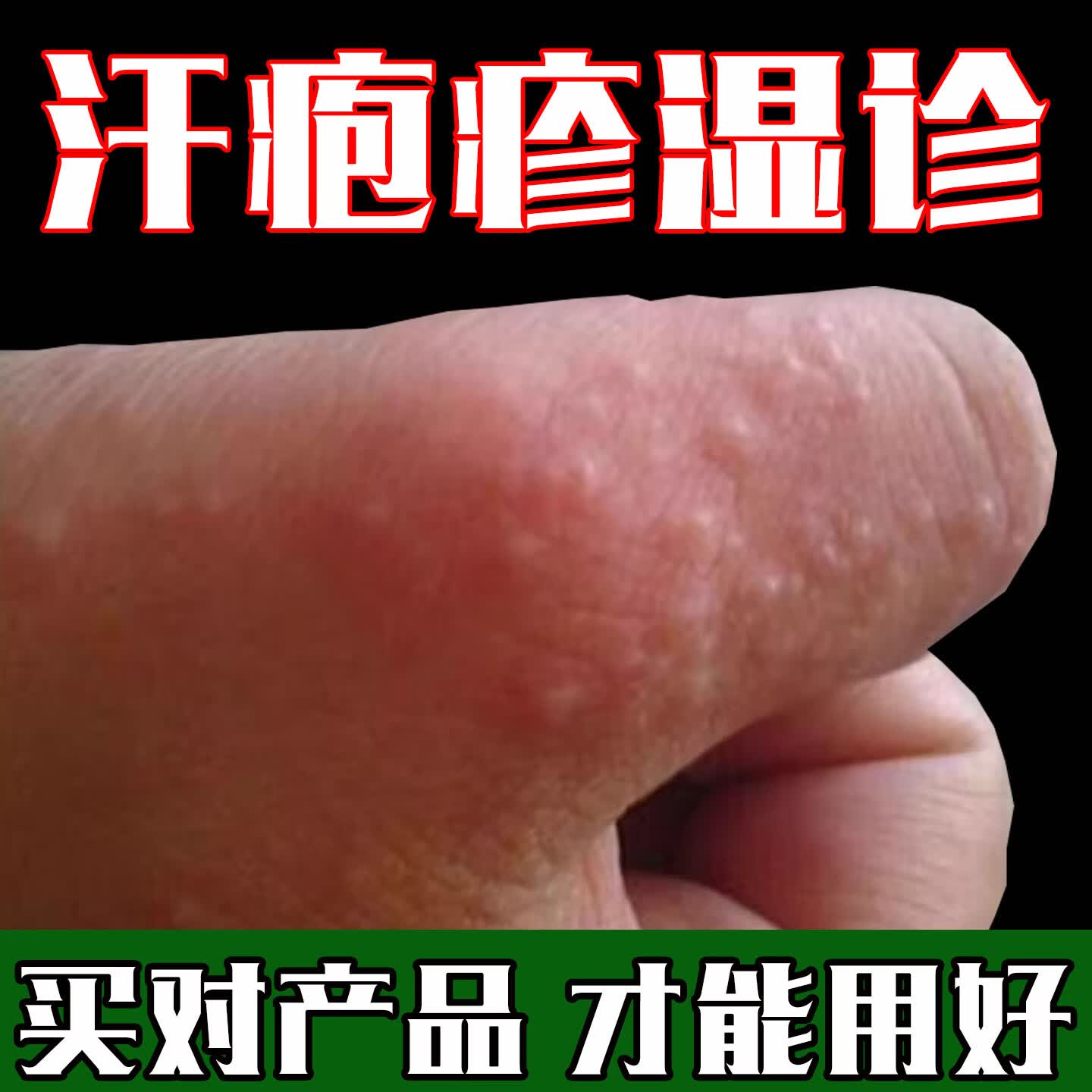 众乐康健(ZHONGLEKANGJIAN)手上起小水泡手痒指长非汗状泡疹专用软膏止痒汗包膏汗泡膏汗孢疹 3盒装【买2送1巩固装】