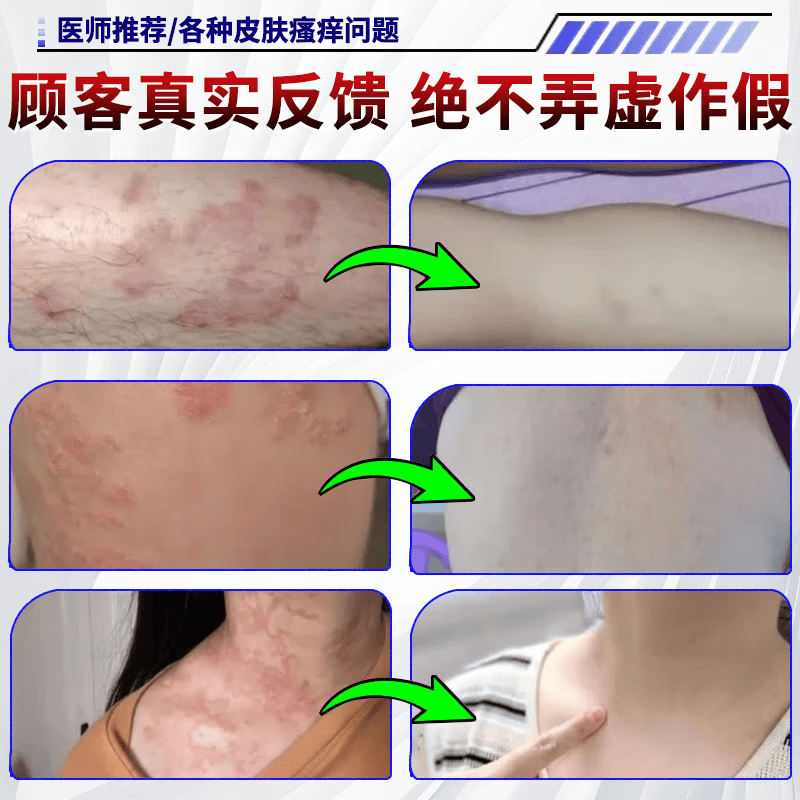 狼毒蛇床子祛痒膏止痒膏抑菌皮肤瘙痒皮湿炎疹真菌感染止痒药膏 特效买2送1【一抹止痒】