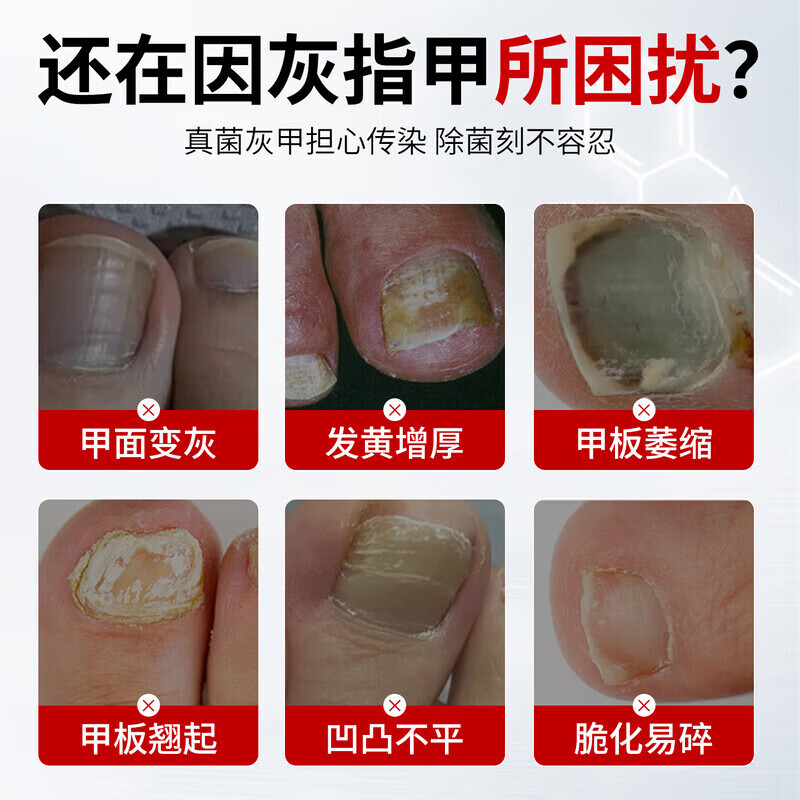 灰指甲特殊效增厚发黄变空中草药水灰甲护凤仙花护理液 【见效装】1盒