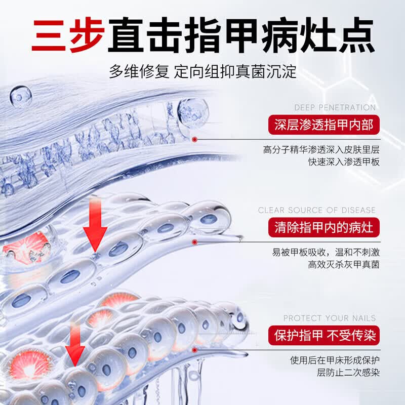 国药药材灰指甲第1名药灰指甲专用指甲真菌感染脱甲坏甲新亮甲根i治抑菌液 1盒装【1-2个推荐】 灰指甲100%特效专用的药第一名