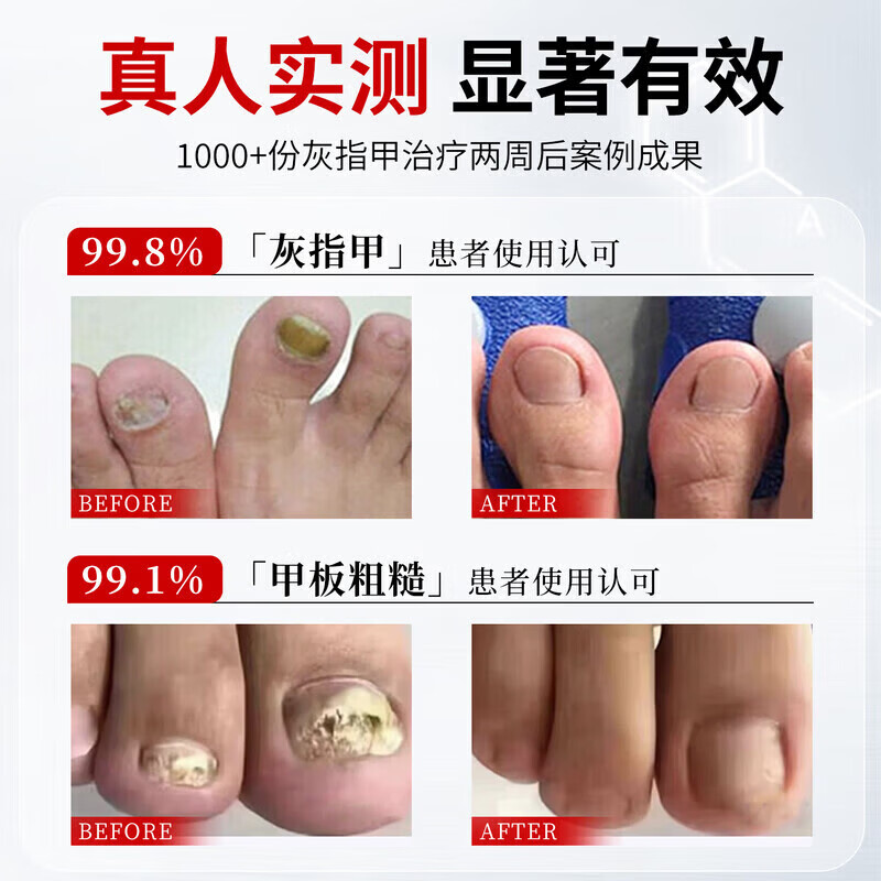 国药药材灰指甲第1名药灰指甲专用指甲真菌感染脱甲坏甲新亮甲根i治抑菌液 1盒装【1-2个推荐】 灰指甲100%特效专用的药第一名